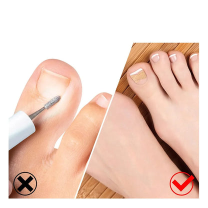 Correcteur Ongle Incarné — Redresseur et Clip de Soin