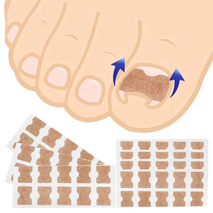 Correcteur Ongle Incarné — Redresseur et Clip de Soin