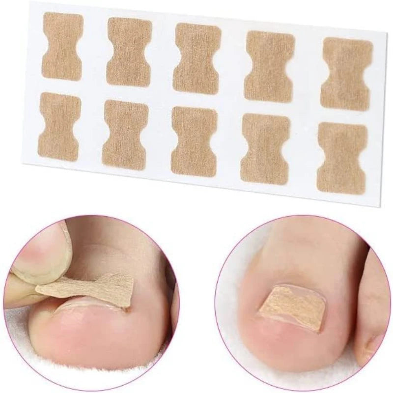 Correcteur Ongle Incarné — Redresseur et Clip de Soin