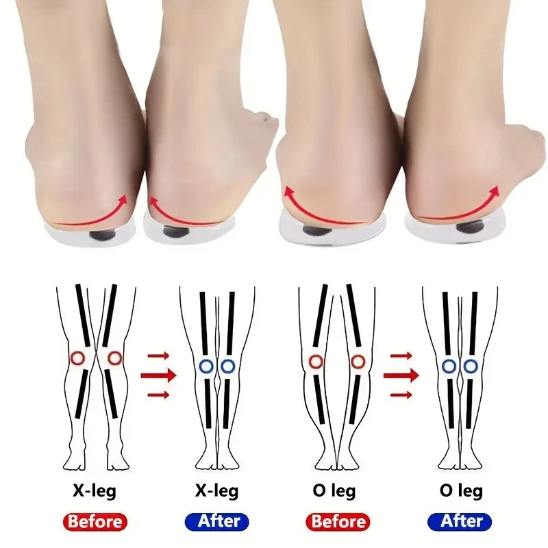 Semelles Gel Correctrices avec Aimants — Correction Valgus, Massage & Soulagement